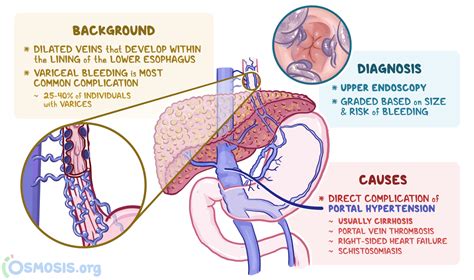 Esophageal Varices: What Are They, Causes, and More | Osmosis