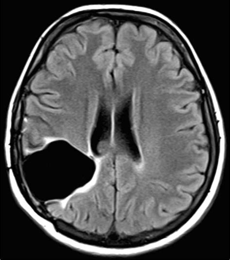 Superficial Siderosis - Neuro MR Case Studies - CTisus CT Scanning