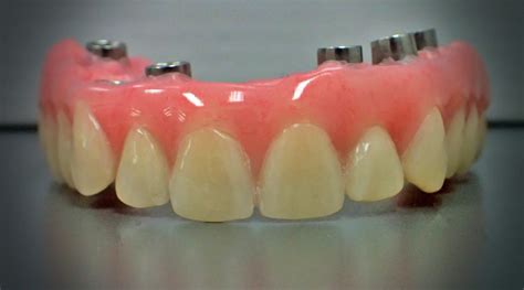 Fixed Implant Retained Hybrid Dentures - ProCare Denture Clinic ...