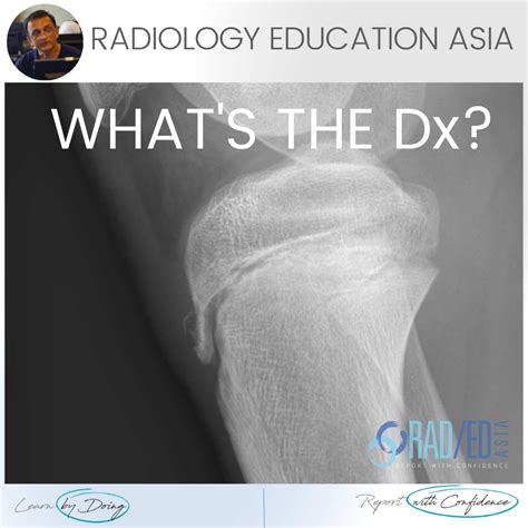 LearningRadiology Osgood-Schlatter Disease, 55% OFF