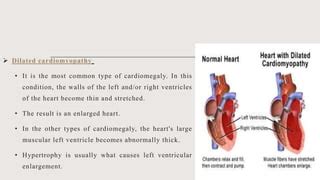 Cardiomegaly | PPT