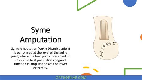 Syme Amputation & Prosthesis | OrthoFixar 2024