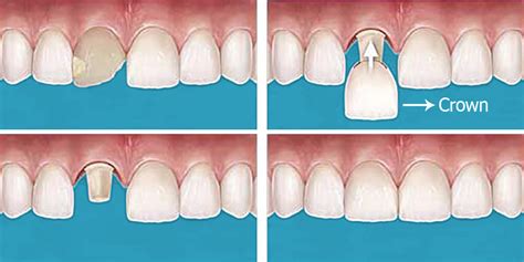 Crown_process – Total Dental and Denture Care by Dr. Lantigua