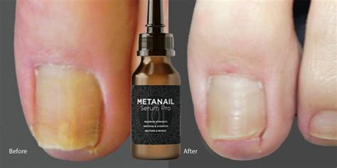 Metanail Serum Pro Complex {Deep Action Formula} Get Healthy And Soft Nails(Work Or Hoax ...