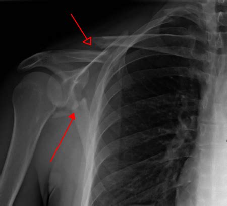 Scapular fracture - WikEM