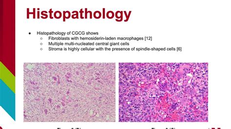 Central Giant Cell Granuloma Histology