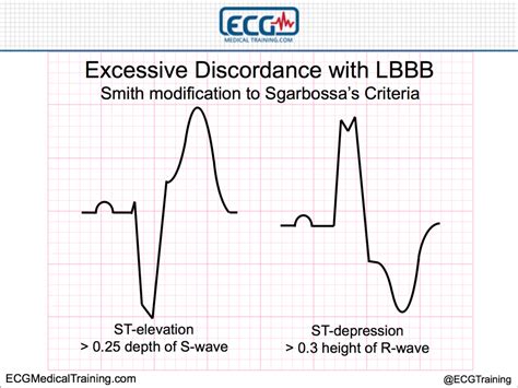 Lbbb Stemi Criteria