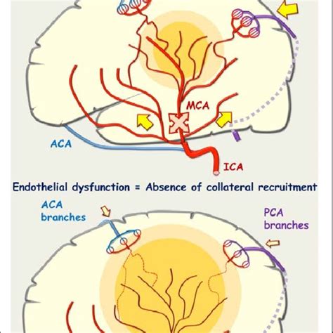 (PDF) Early Collateral Recruitment After Stroke in Infants and Adults ...