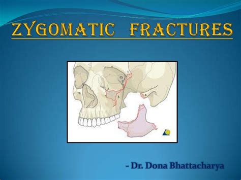 Zygomatic fractures