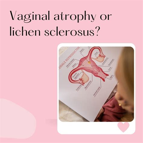 All about lichen sclerosus symptoms causes and treatment – Artofit