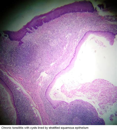 Epidermoid Cyst Histology