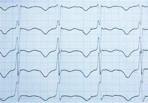 What Is an Irregular Heartbeat? | 1MD