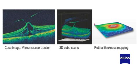 Optical Coherence Tomography - Noosa Optical - Noosa Junction