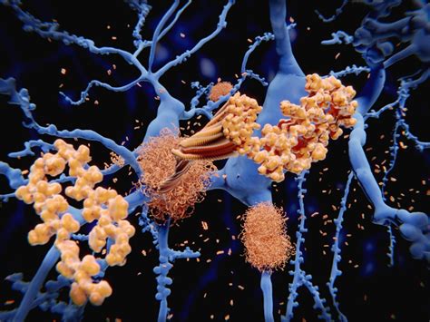 Alzheimer's "Seeding-Prone" Beta Amyloid Structure Determined