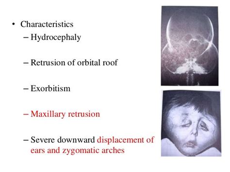 craniofacial anomalies