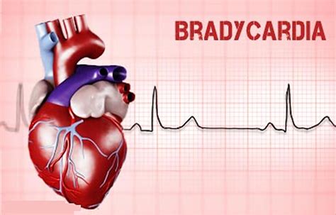 Bradycardia - Sinus Bradycardia Causes, Symptoms, Diagnosis, Treatment