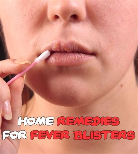 Get Rid Of Fever Blisters With These Home Remedies For Fever Blisters ...