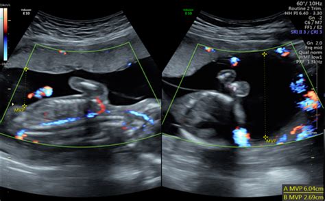 Surveillance of Monochorionic Twins