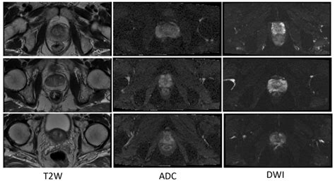 Some examples of T2W, ADC and DWI MR images from our dataset, which... | Download Scientific Diagram