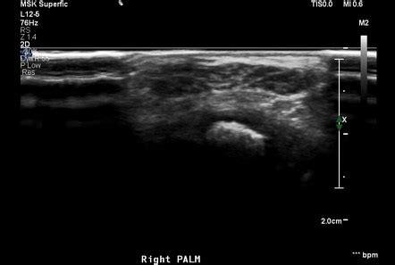 Lipomatosis of nerve | Radiology Reference Article | Radiopaedia.org