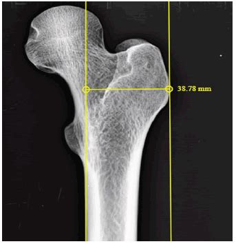 Morphological variation in proximal femur anatomy and its implication in metaphyseal fit femur ...