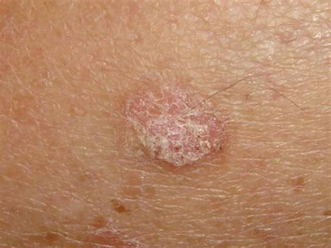 Actinic Keratosis (Solar Keratosis) - The Skin Doctor