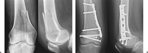 Femur Bone Fracture Surgery