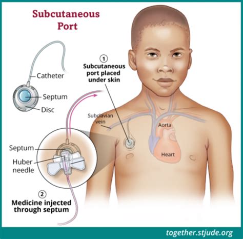 Subcutaneous Port for Pediatric Cancer Patients - Together by St. Jude™