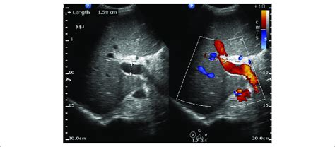 Ultrasound abdomen: ultrasound of liver identifies a patent portal... | Download Scientific Diagram