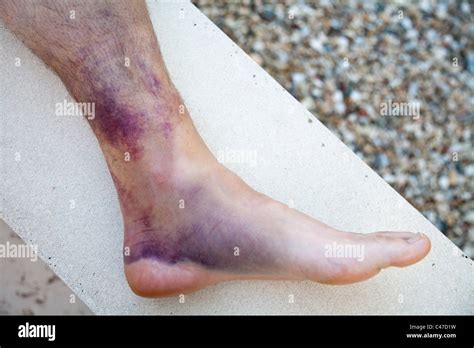 Bruised ankle injury with torn ligaments Stock Photo - Alamy