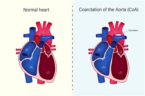 Aortic coarctation: causes and symptoms of aortic narrowing ...