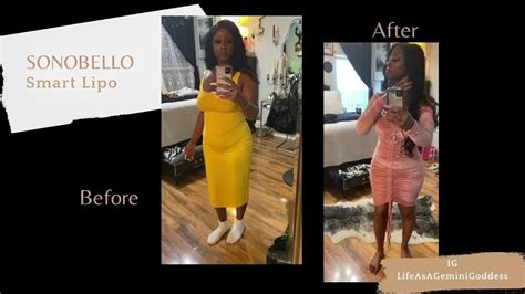 Sono Bello: Before and After - The Smart Lipo Journey