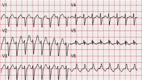 Gambar Ekg Svt – retorika