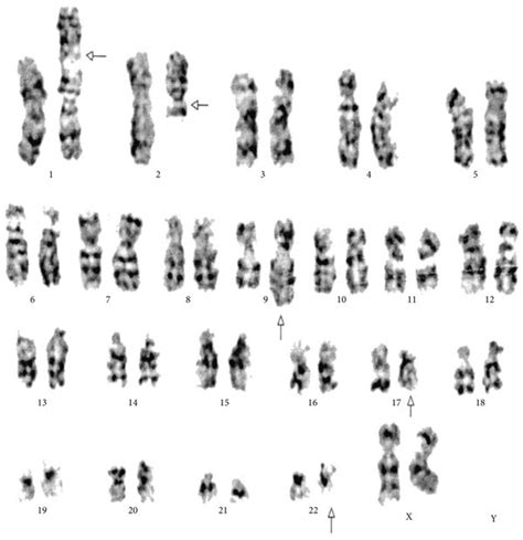 Cytogenetic analysis shows karyotype of five-way complex translocation... | Download Scientific ...