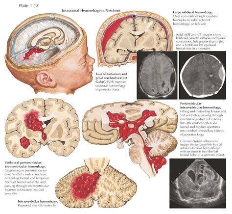 INTRACRANIAL HEMORRHAGE IN THE NEWBORN - pediagenosis