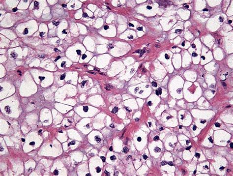 Current Pathology Keys of Renal Cell Carcinoma - European Urology