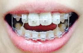 14 best Radiance Plus Clear Sapphire Braces - Before and After images on Pinterest | Sapphire ...