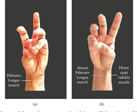 Palmaris Longus Muscle Test