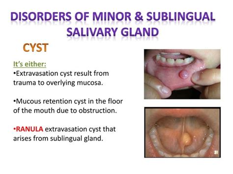 Salivary glands anatomy clinical features and diseases management | PPT