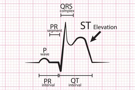 Study: STEMI Often Not What It Appears in COVID-19 | MedPage Today