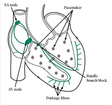 Figure 1 from Detection of Life Threatening Ventricular Arrhythmia Using Digital Taylor Fourier ...