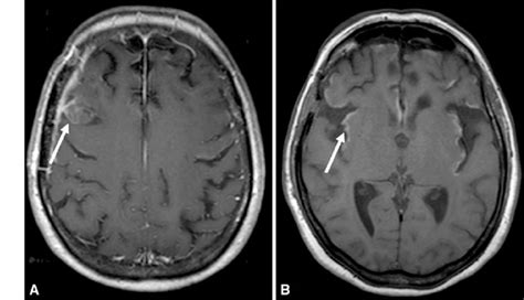 MRI scan taken 3 months postoperatively, revealing local tumor ...