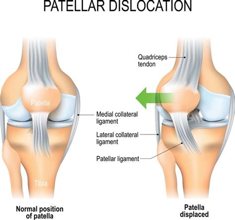 Is It East to Dislocate Your Patellar Again - Terry Olower