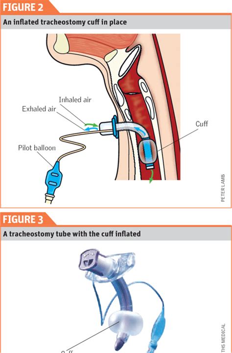 How to measure tracheostomy tube cuff pressure. | Semantic Scholar