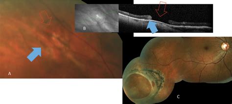 Atrophic Retinal Hole - A Pictures Of Hole 2018