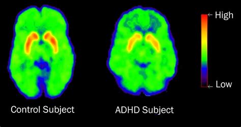 Genetic Insight into ADHD