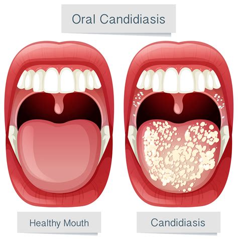 Does Your Sore Throat Need an Antibiotic? - JASE Medical