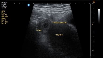 Abdominal Ectopic Pregnancy