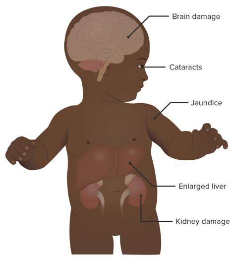 Galactosemia | Concise Medical Knowledge