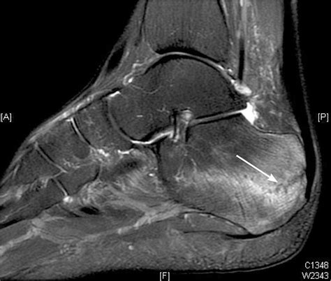 Heel Pain: Diagnosis and Management | AAFP